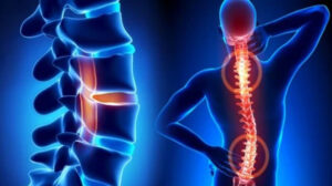 How nomgwa confronts spine disorders